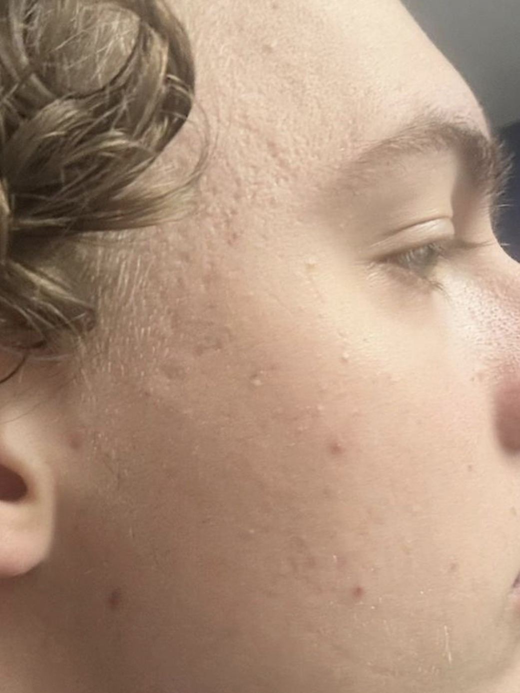 Skin after