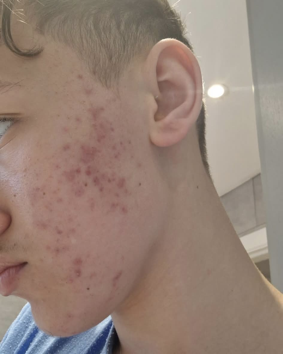 Skin before