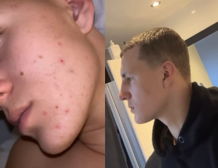 Client skin before and after transformation